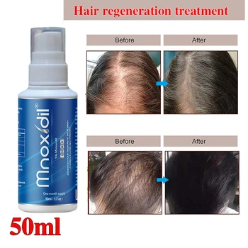 Saç özü sprey anti alopesi tedavisi uçucu yağ alopesi önlemek için, pekiştirmek ve besler saç kökleri